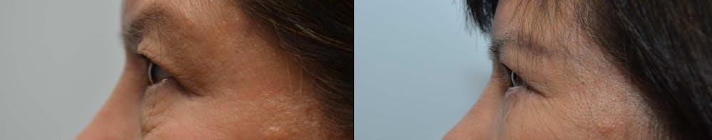 Asian Eyelid Surgery Before & After Gallery - Patient 4588567 - Image 4