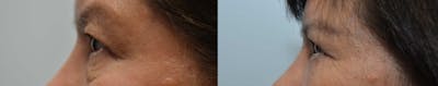 Eyelid Surgery Before & After Gallery - Patient 4588594 - Image 4
