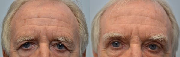 Eyelid Surgery Gallery | Tansavatdi Cosmetic & Reconstructive Surgery