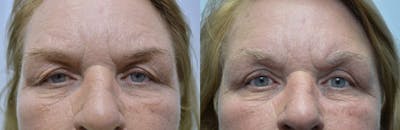 Eyelid Surgery Before & After Gallery - Patient 4588601 - Image 1
