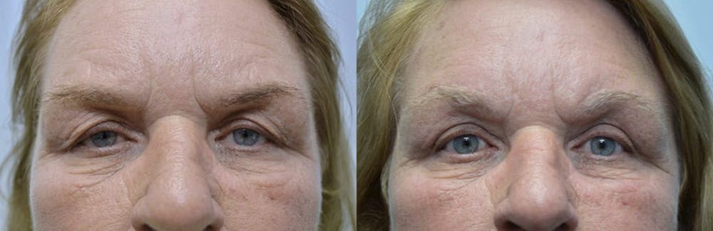 Eyelid Surgery Before & After Gallery - Patient 4588601 - Image 1