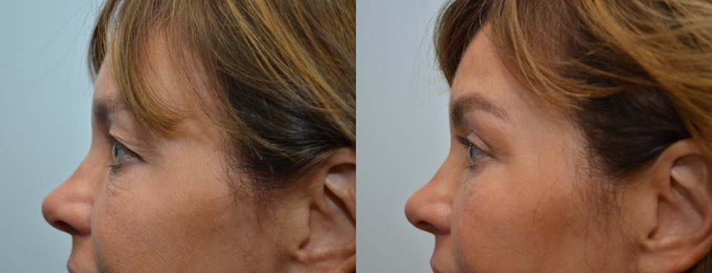 Eyelid Surgery Before & After Gallery - Patient 4588602 - Image 3