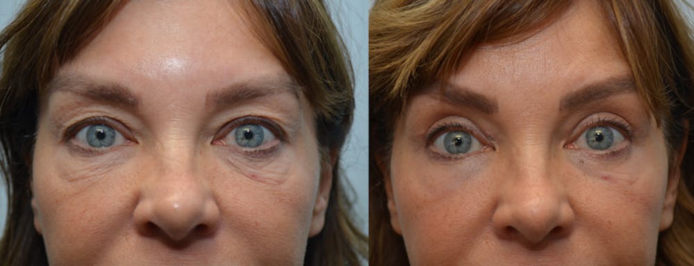 Eyelid Surgery Before & After Gallery - Patient 4588602 - Image 1