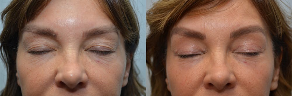 Eyelid Surgery Before & After Gallery - Patient 4588602 - Image 2