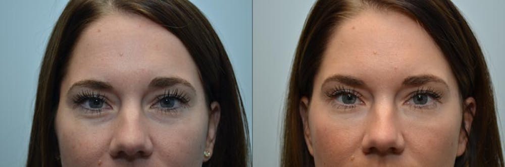 Under Eye Rejuvenation Before & After Gallery - Patient 4588628 - Image 1