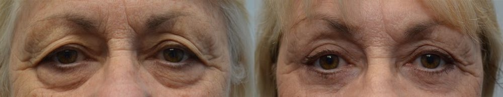 Brow Lift (Forehead Lift) Before & After Gallery - Patient 4588635 - Image 1