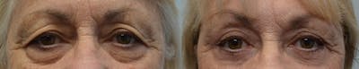 Brow Lift (Forehead Lift) Before & After Gallery - Patient 4588635 - Image 1