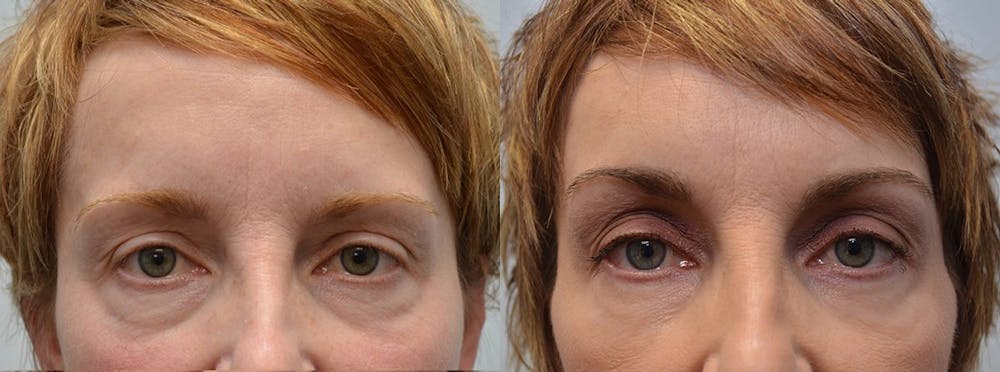 Brow Lift (Forehead Lift) Gallery - Patient 4588636 - Image 1