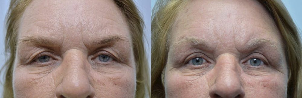 Brow Lift (Forehead Lift) Before & After Gallery - Patient 4588639 - Image 1