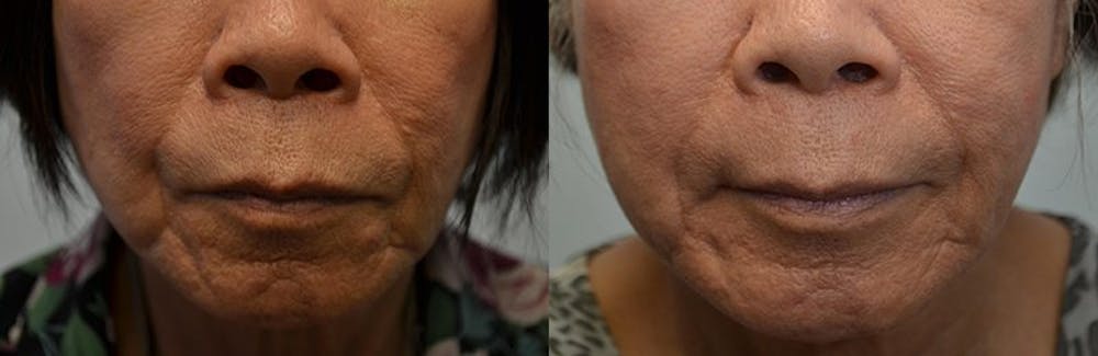 Facial Revolumizing (Fat Transfer) Before & After Gallery - Patient 4588774 - Image 2
