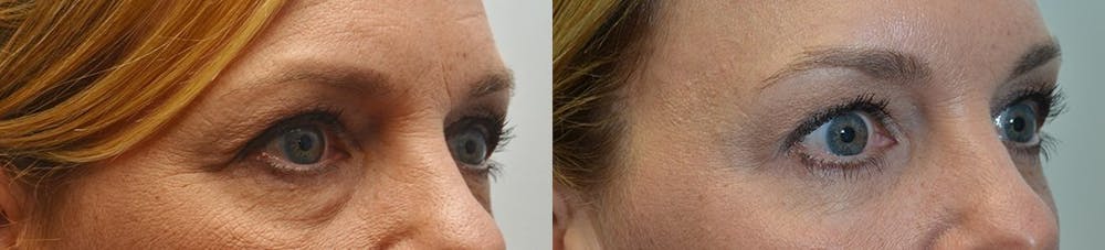 Facial Revolumizing (Fat Transfer) Before & After Gallery - Patient 4588777 - Image 1