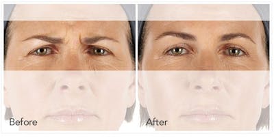 Botox / Xeomin Before & After Gallery - Patient 4588776 - Image 1