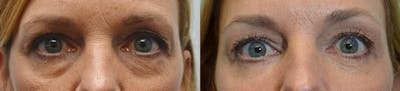 Facial Revolumizing (Fat Transfer) Before & After Gallery - Patient 4588777 - Image 2