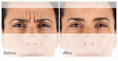 Botox / Xeomin Before & After Gallery - Patient 4588778 - Image 1