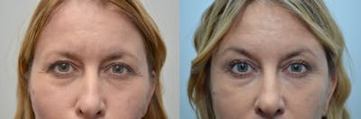 Botox / Xeomin Before & After Gallery - Patient 4588782 - Image 1