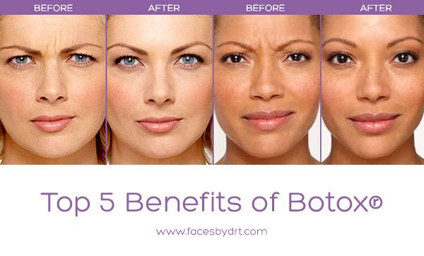 Top 5 Benefits of Botox® - Dr. Kristina Tansavatdi