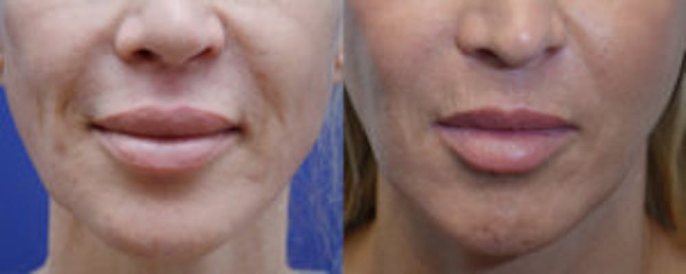 Non-Surgical Soft Tissue Fillers Before & After Gallery - Patient 4594095 - Image 1