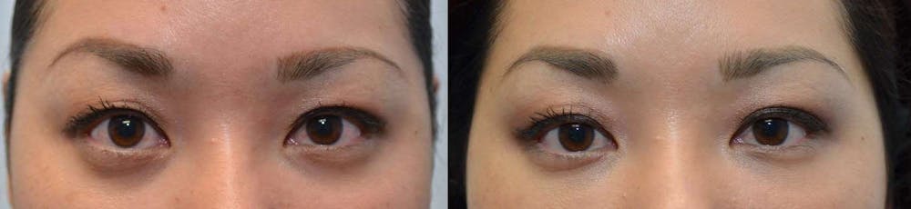 Non-Surgical Soft Tissue Fillers Before & After Gallery - Patient 4594099 - Image 1