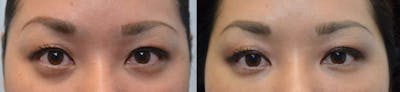 Non-Surgical Soft Tissue Fillers Before & After Gallery - Patient 4594099 - Image 1