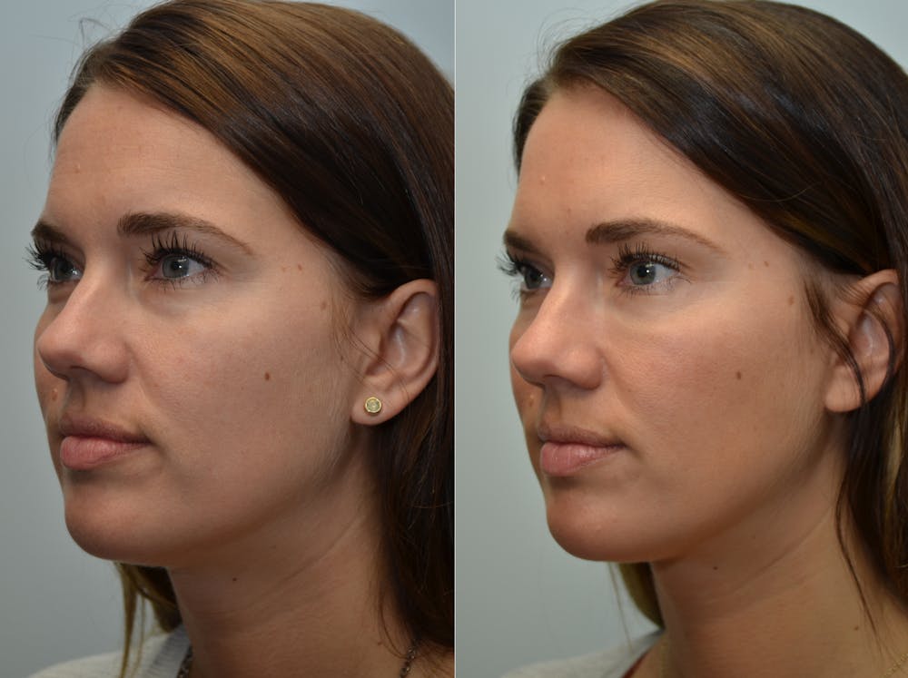 Non-Surgical Soft Tissue Fillers Before & After Gallery - Patient 4594103 - Image 1