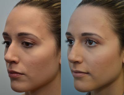Non-Surgical Soft Tissue Fillers Before & After Gallery - Patient 4594105 - Image 1