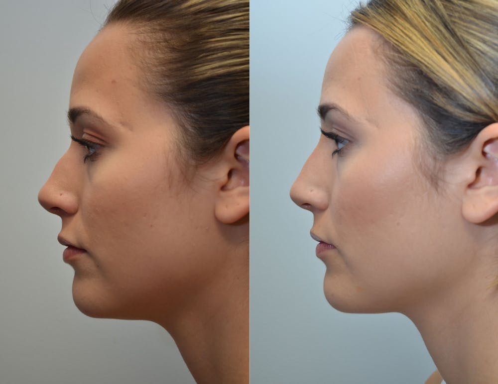 Non-Surgical Soft Tissue Fillers Before & After Gallery - Patient 4594105 - Image 2