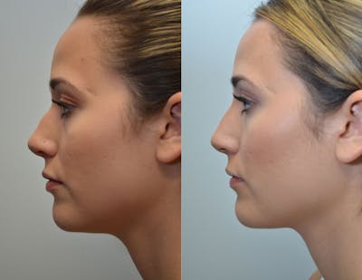 Non-Surgical Soft Tissue Fillers Before & After Gallery - Patient 4594105 - Image 2