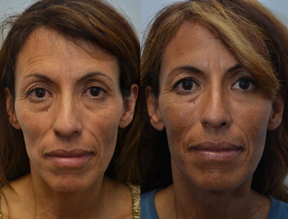 Non-Surgical Soft Tissue Fillers Before & After Gallery - Patient 4630996 - Image 1