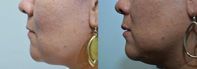 Lip Enhancement Before & After Gallery - Patient 4588509 - Image 2