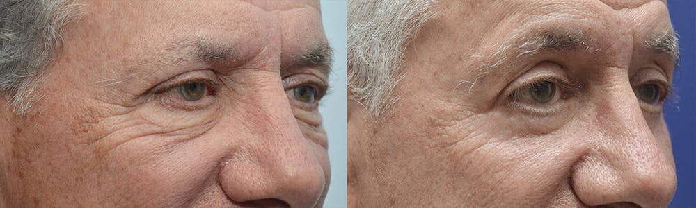 Eyelid Surgery Before & After Gallery - Patient 4588566 - Image 2