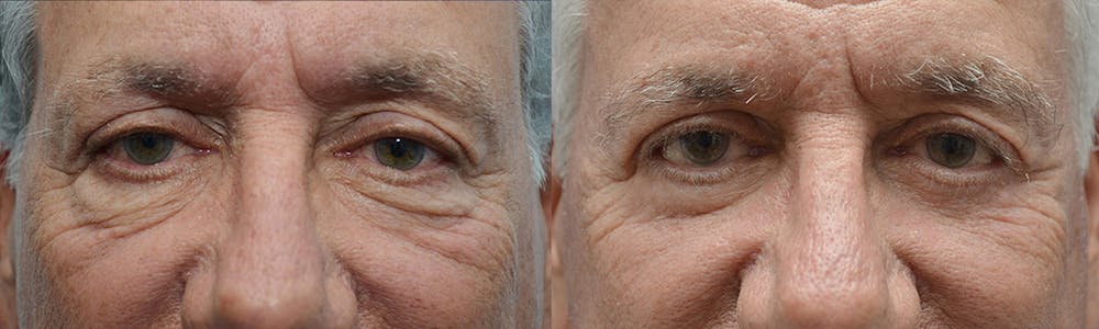 Eyelid Surgery Before & After Gallery - Patient 4588566 - Image 1
