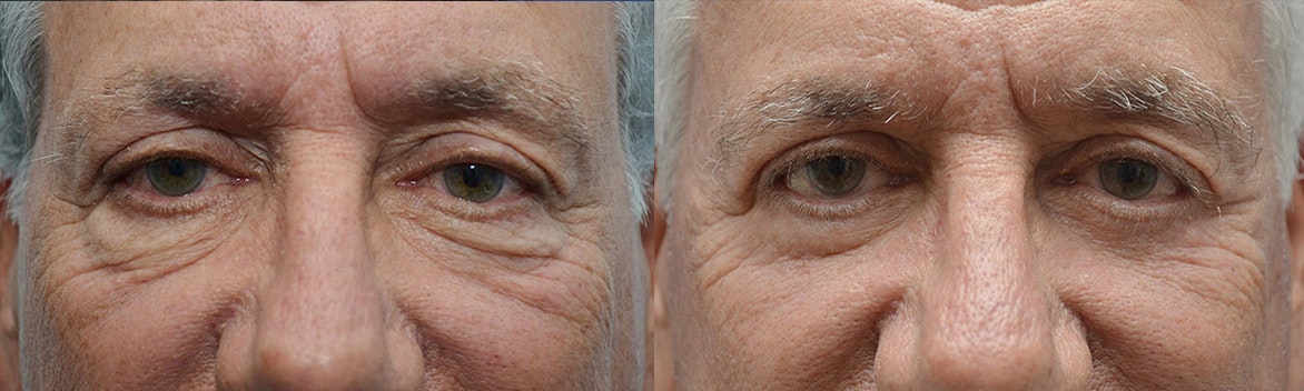 Westlake Village Eyelid Surgery