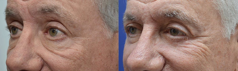 Eyelid Surgery Before & After Gallery - Patient 4588566 - Image 3