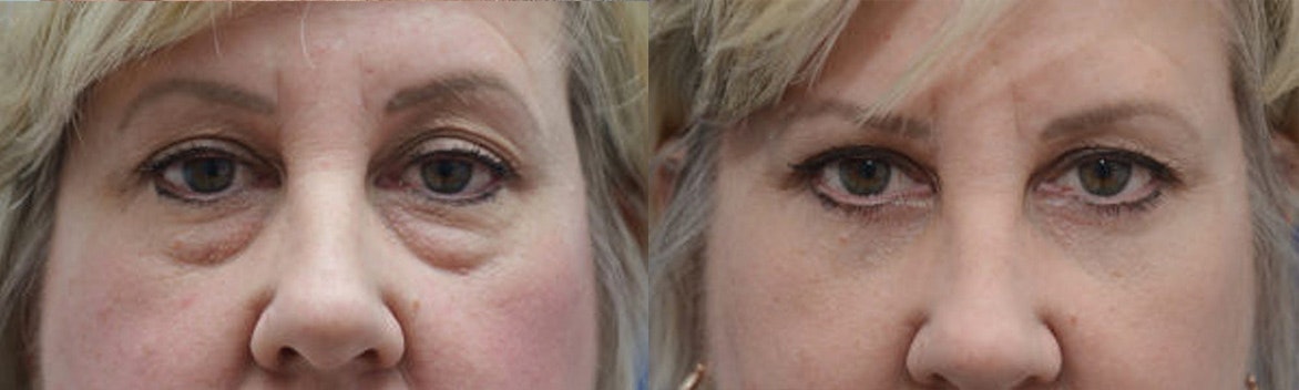 Thousand Oaks Eyelid Surgery