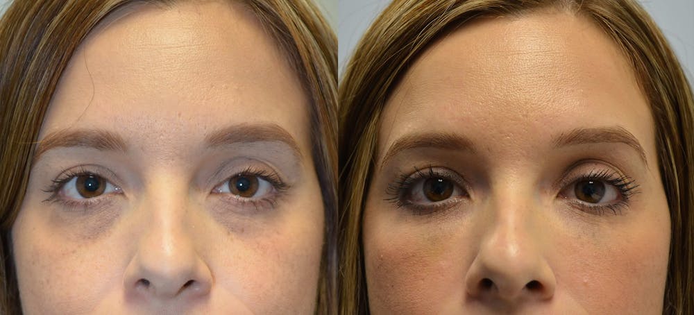 Non-Surgical Soft Tissue Fillers Before & After Gallery - Patient 4594131 - Image 1