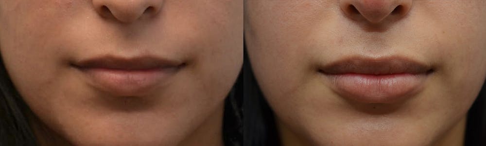 Non-Surgical Soft Tissue Fillers Before & After Gallery - Patient 4594094 - Image 1
