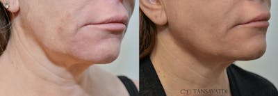 Facetite™: Non-Surgical Facelift Before & After Gallery - Patient 4588396 - Image 1