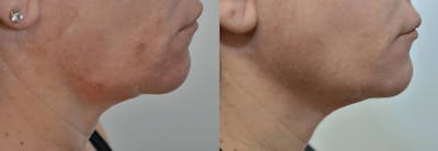 Facetite™: Non-Surgical Facelift Before & After Gallery - Patient 4588396 - Image 2