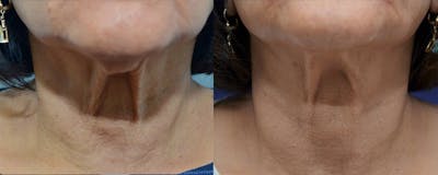 Fractora Before & After Gallery - Patient 4588399 - Image 2