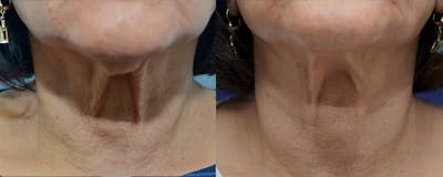RF Microneedling Before & After Gallery - Patient 4588451 - Image 2