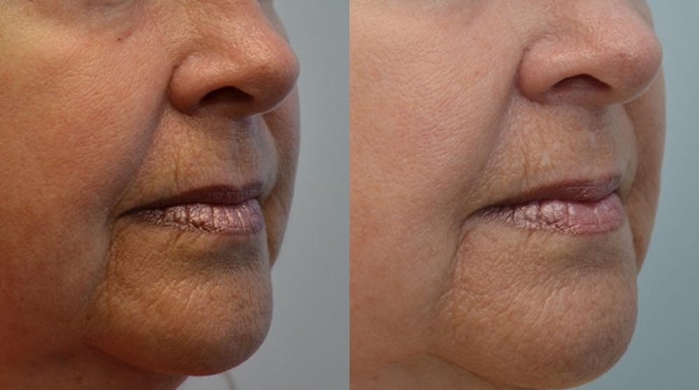 RF Microneedling Before & After Gallery - Patient 4588452 - Image 1