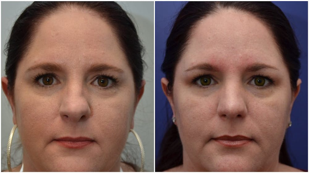 Rhinoplasty (Nose Reshaping) Before & After Gallery - Patient 4588534 - Image 1