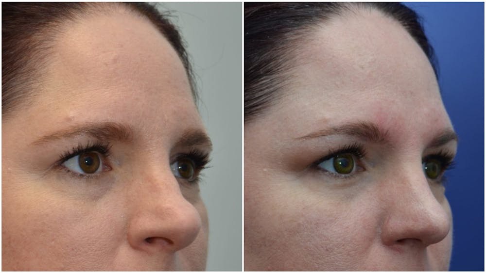 Rhinoplasty (Nose Reshaping) Before & After Gallery - Patient 4588534 - Image 2