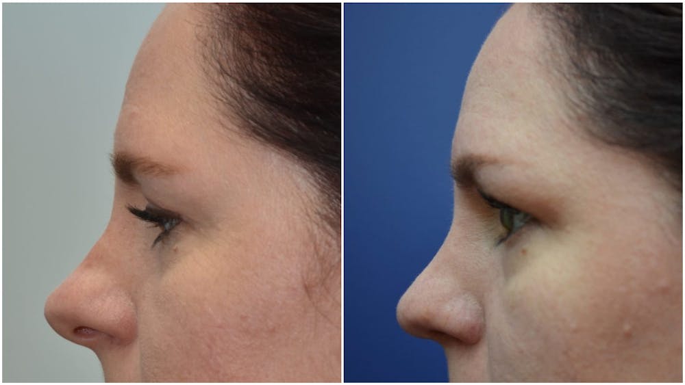 Rhinoplasty (Nose Reshaping) Before & After Gallery - Patient 4588534 - Image 3