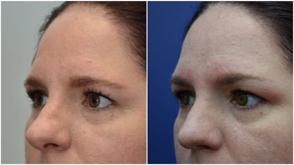 Rhinoplasty (Nose Reshaping) Before & After Gallery - Patient 4588534 - Image 4