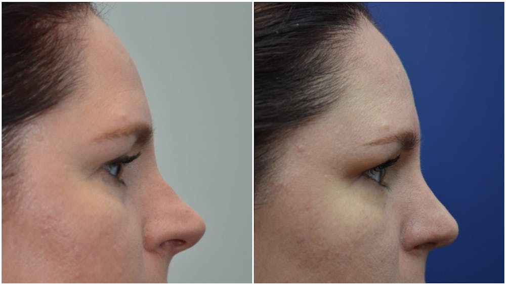 Rhinoplasty (Nose Reshaping) Before & After Gallery - Patient 4588534 - Image 5