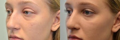 Rhinoplasty (Nose Reshaping) Before & After Gallery - Patient 4631071 - Image 2