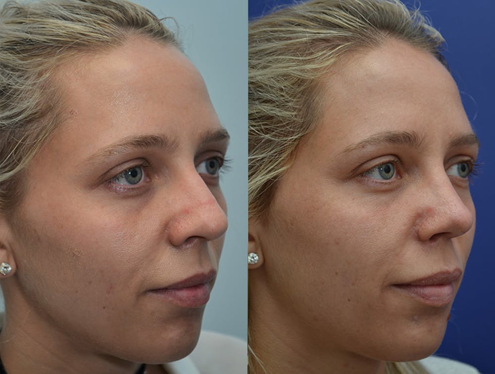 Rhinoplasty (Nose Reshaping) Before & After Gallery - Patient 4631072 - Image 3