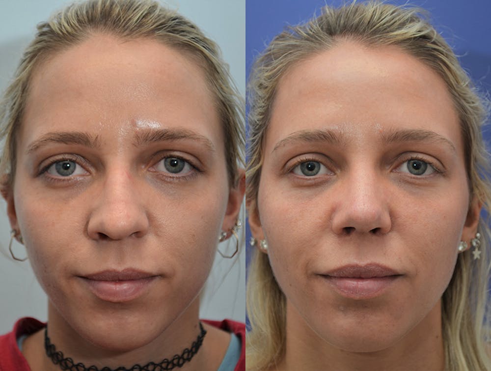 Rhinoplasty (Nose Reshaping) Before & After Gallery - Patient 4631072 - Image 1