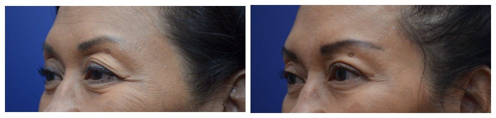 Upper Eyelid Ptosis Repair Before & After Gallery - Patient 4588779 - Image 3